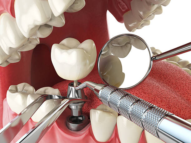 Best Emergency Tooth Extraction in Compo, CT